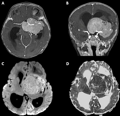 脑膜瘤不做手术可以吗？侵袭性WHO 2级脑膜瘤案例一则