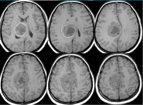 质子治疗室管膜瘤