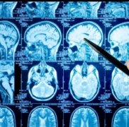 一文深度读懂低级别胶质瘤，治疗、预后、复发、恶化