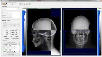 脑瘤质子治疗案例