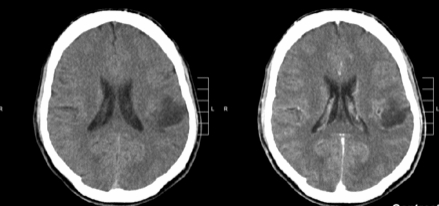 <a href='/qianyan/zhizizhiliao/' target='_blank'><u>质子治疗</u></a>胶质瘤