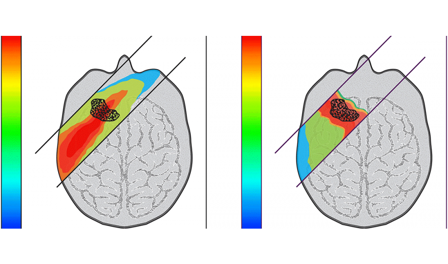 质子治疗髓母细胞瘤