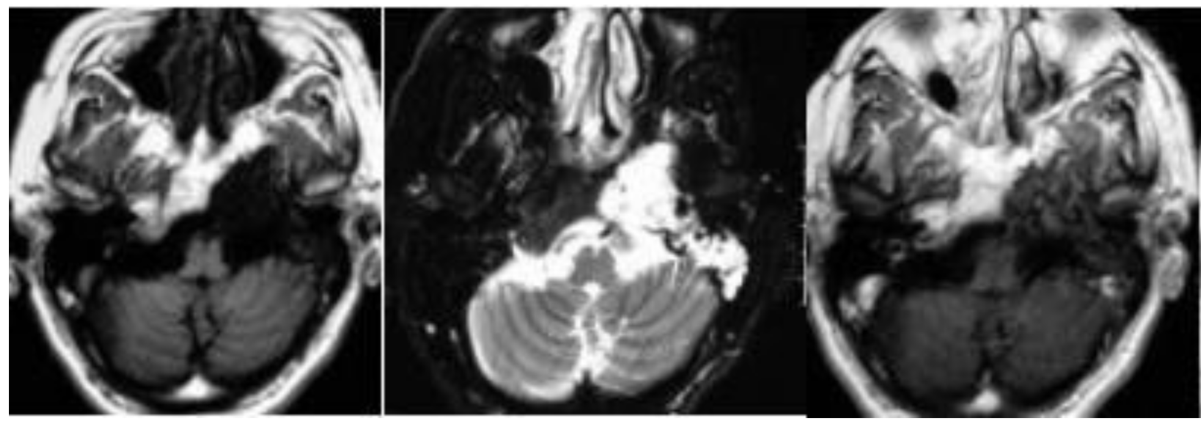 <a href='/bingzhong/chuitiliu/' target='_blank'><u>垂体瘤</u></a>