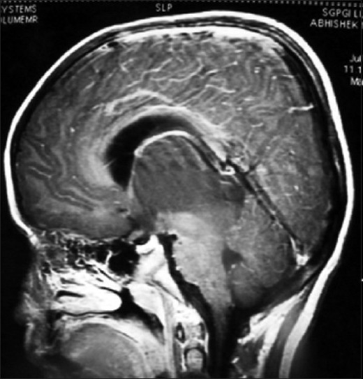丘脑胶质瘤的治疗方法：6岁儿童双侧丘脑胶质瘤