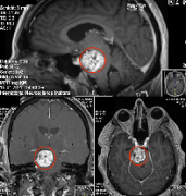 【手术报告】罕见滑车神经鞘瘤误诊为中脑脑膜瘤，二次手术成功全切