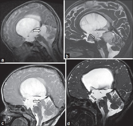 脑积水、胶质瘤能治好吗？