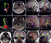 脑干胶质瘤影像学、病理学、分子学分型