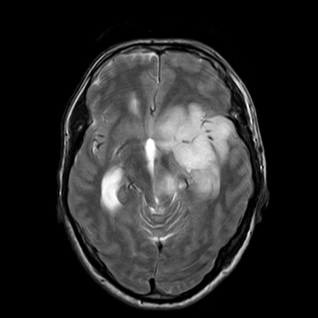 低级别胶质瘤恶性转化研究，观察可能让你的肿瘤变成高级别