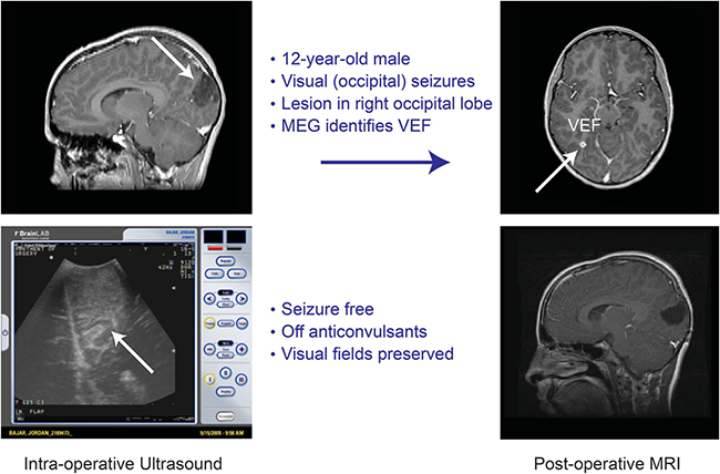难治性癫痫案例