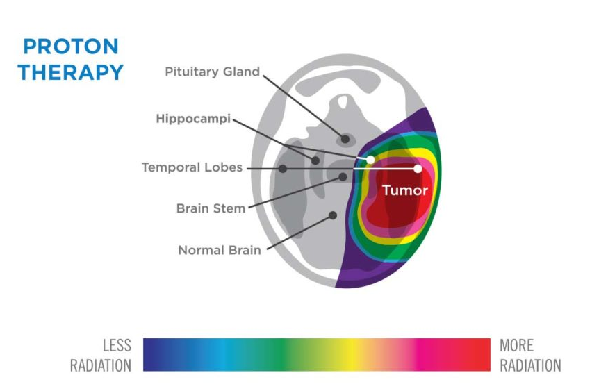 美国国家癌症数据库（NVBD）：质子与光子放疗治疗胶质瘤的对比分析