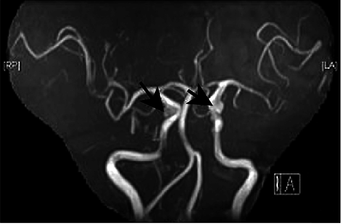 <a href='/baike/naodongmailiu.html' target='_blank'><u>脑动脉瘤</u></a>