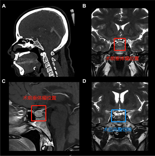 孩子总是长不高，原来是垂体瘤在作怪