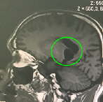 深度解读：丘脑胶质瘤生存期有多久？