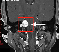 听神经瘤手术后面瘫多久能恢复？术前需要做什么准备？