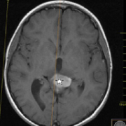 小儿颅内原发性间变性神经节胶质瘤——INC意大利Concezio Di Rocco教授