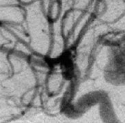 什么人容易得脑动脉瘤？