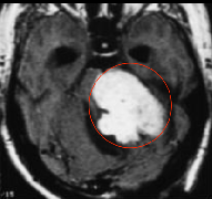 听神经瘤是大手术吗？术后听不见、面瘫的概率高不高？