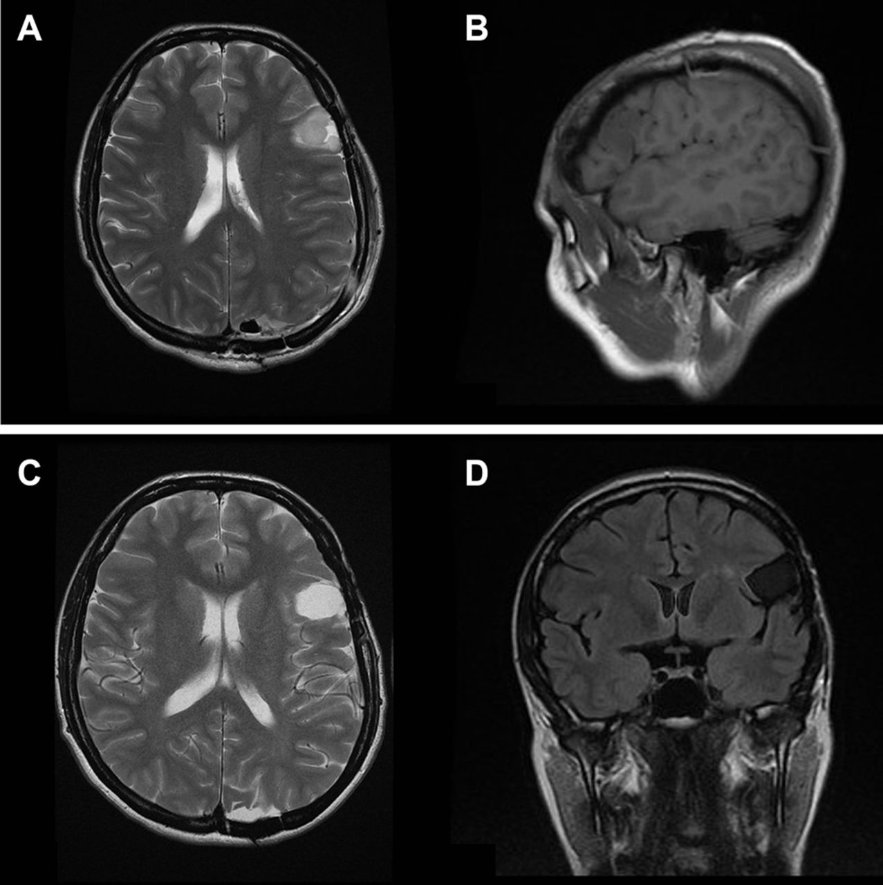 4级脑胶质瘤能活几年？