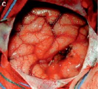 儿童术后癫痫发作：脑切口是一个危险因素吗？
