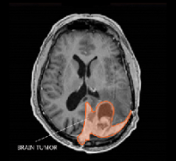脑膜瘤复发率高吗？