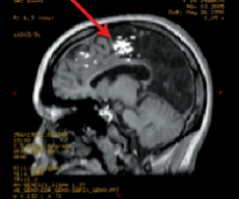 癫痫病人吃药为何还会发作？癫痫停药后复发率高吗?