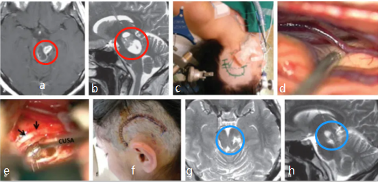 <a href='/qianyan/xueguanliu/' target='_blank'><u>脑干海绵状血管瘤</u></a>