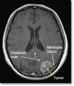 左侧岩尖脑膜瘤的早期症状