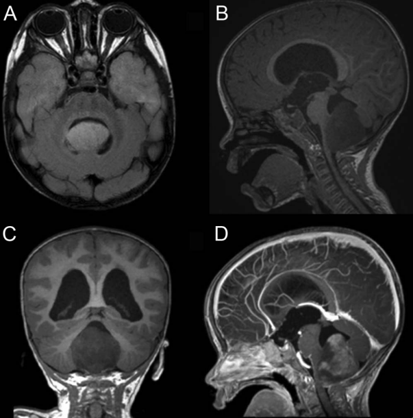 儿童神经学：颈髓脑干肿瘤的间脑综合征样表现