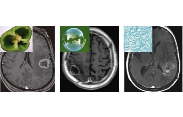 <a href='/bingzhong/jiaozhiliu/' target='_blank'><u>胶质瘤</u></a>复发