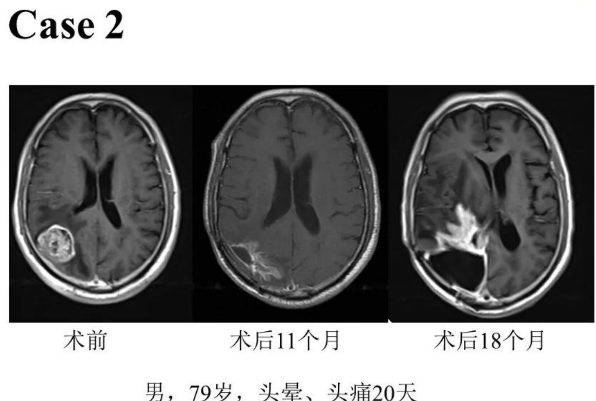 大脑胶质瘤病的影像学特征 | The Neurosurgical Atlas全文翻译
