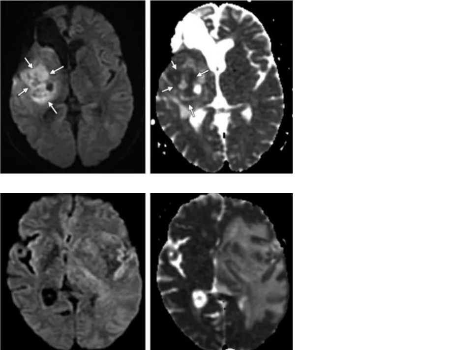 <a href='/qianyan/naozhongliu/' target='_blank'><u>脑肿瘤</u></a>复发