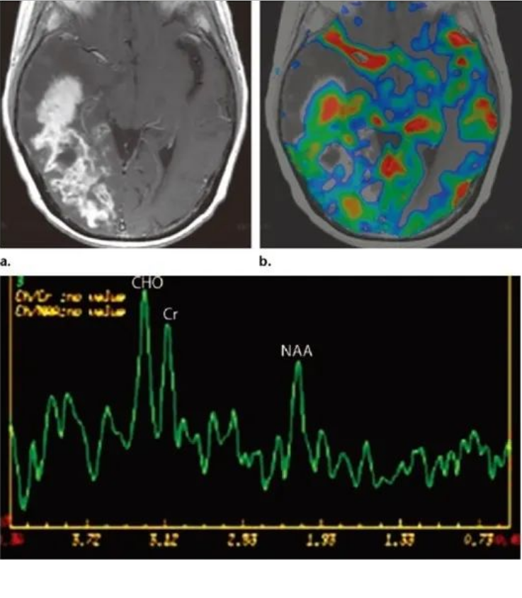 <a href='/jibing/naojiaozhiliu/1548.html' target='_blank'><u>胶质瘤治疗</u></a>