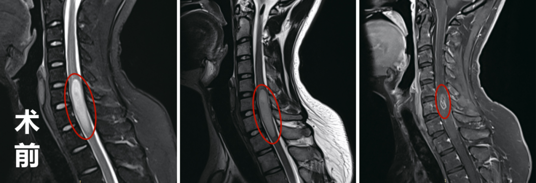 <a href='/bingzhong/jiaozhiliu/' target='_blank'><u>胶质瘤</u></a>术前