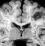 脑血管畸形怎么治疗？