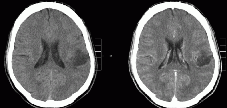 胶质瘤早期症状