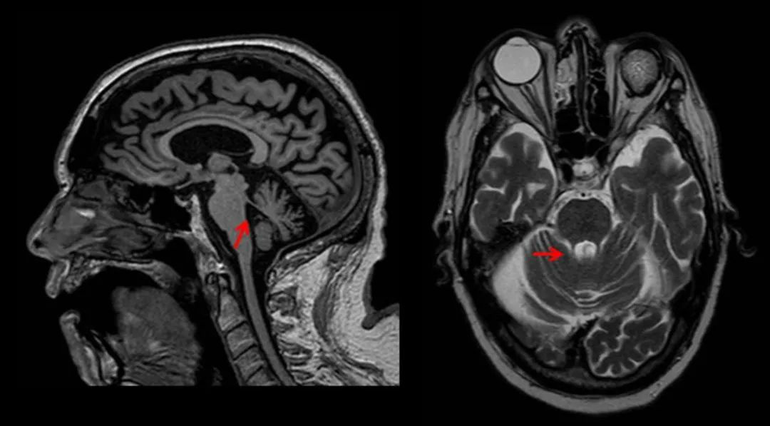 PSP中小脑上脚萎缩