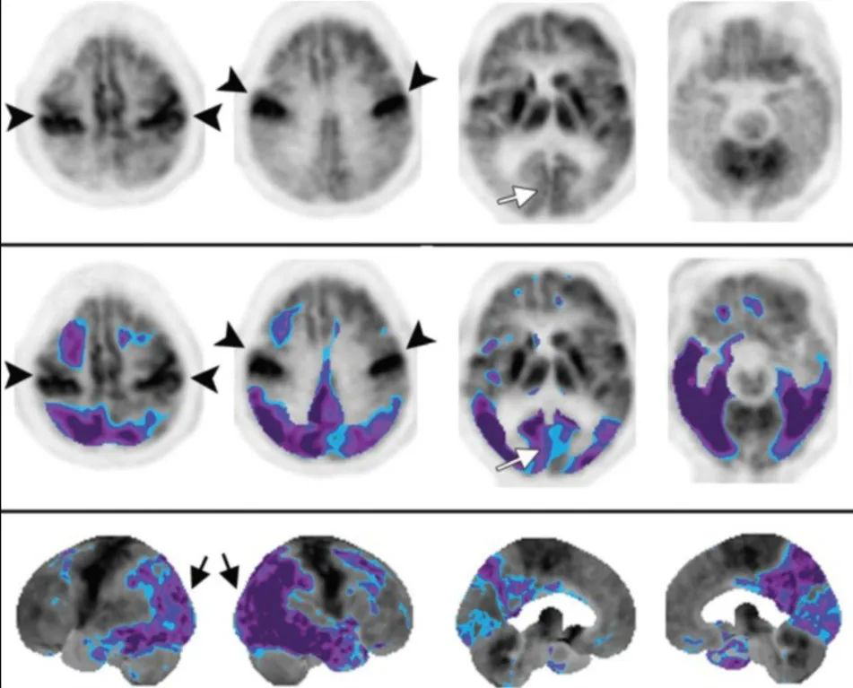 双侧前额叶、顶叶、颞叶和后扣带回-丘脑前皮质低代谢