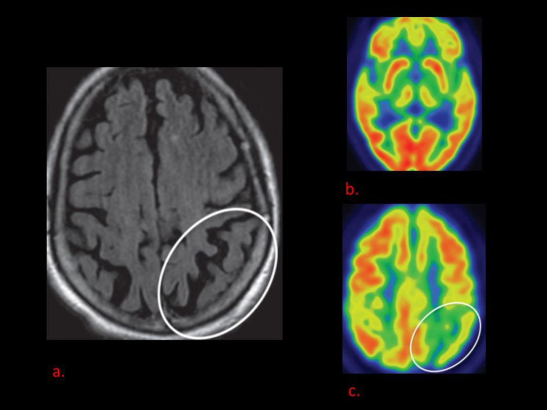 顶叶萎缩伴皮层代谢减低