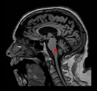 帕金森病和帕金森综合征的影像