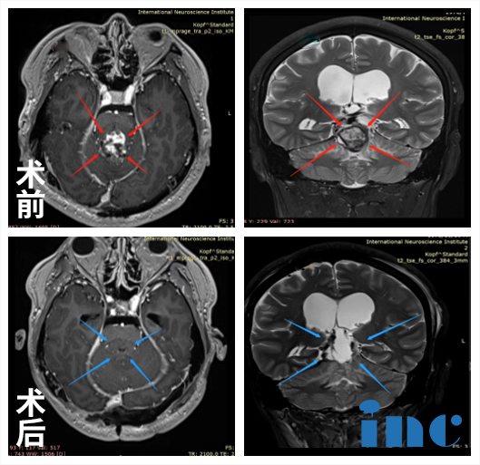松果体肿瘤案例——脑瘤治疗案例图片