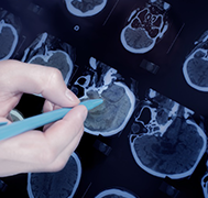 癫疯病怎么治疗？癫痫病手术效果怎么样？