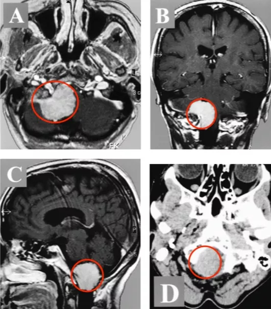 枕骨大孔区脑膜瘤全切案例
