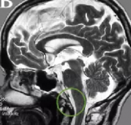 枕骨大孔区脑膜瘤治愈率