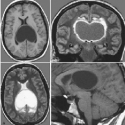 脑室内肿瘤手术危险性大吗？脑室内胶质瘤案例解读