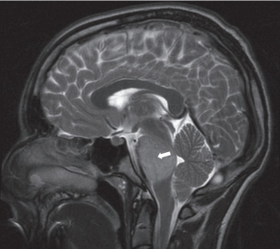 脑胶质瘤是什么病？得了DIPG就无法治疗了吗？