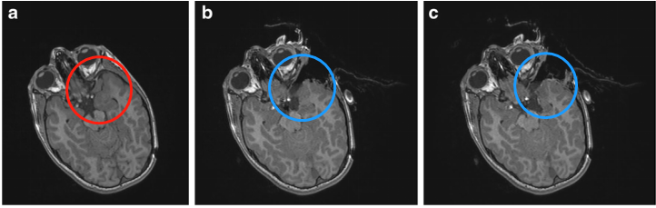 神经胶质瘤案例