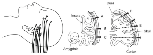 <a href='/qianyan/litt/' target='_blank'><u>LITT</u></a>