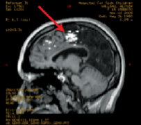 现代癫痫外科手术的“七大技术”