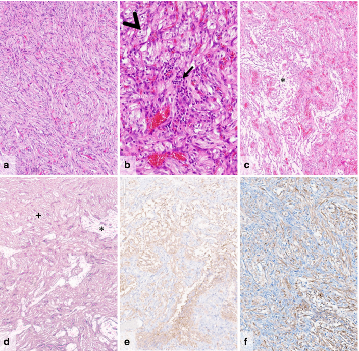 纤维增生性胶质瘤