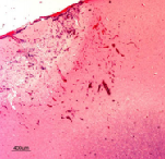 INC加拿大James Rutka教授：小儿癫痫手术并发的微观和宏观梗塞